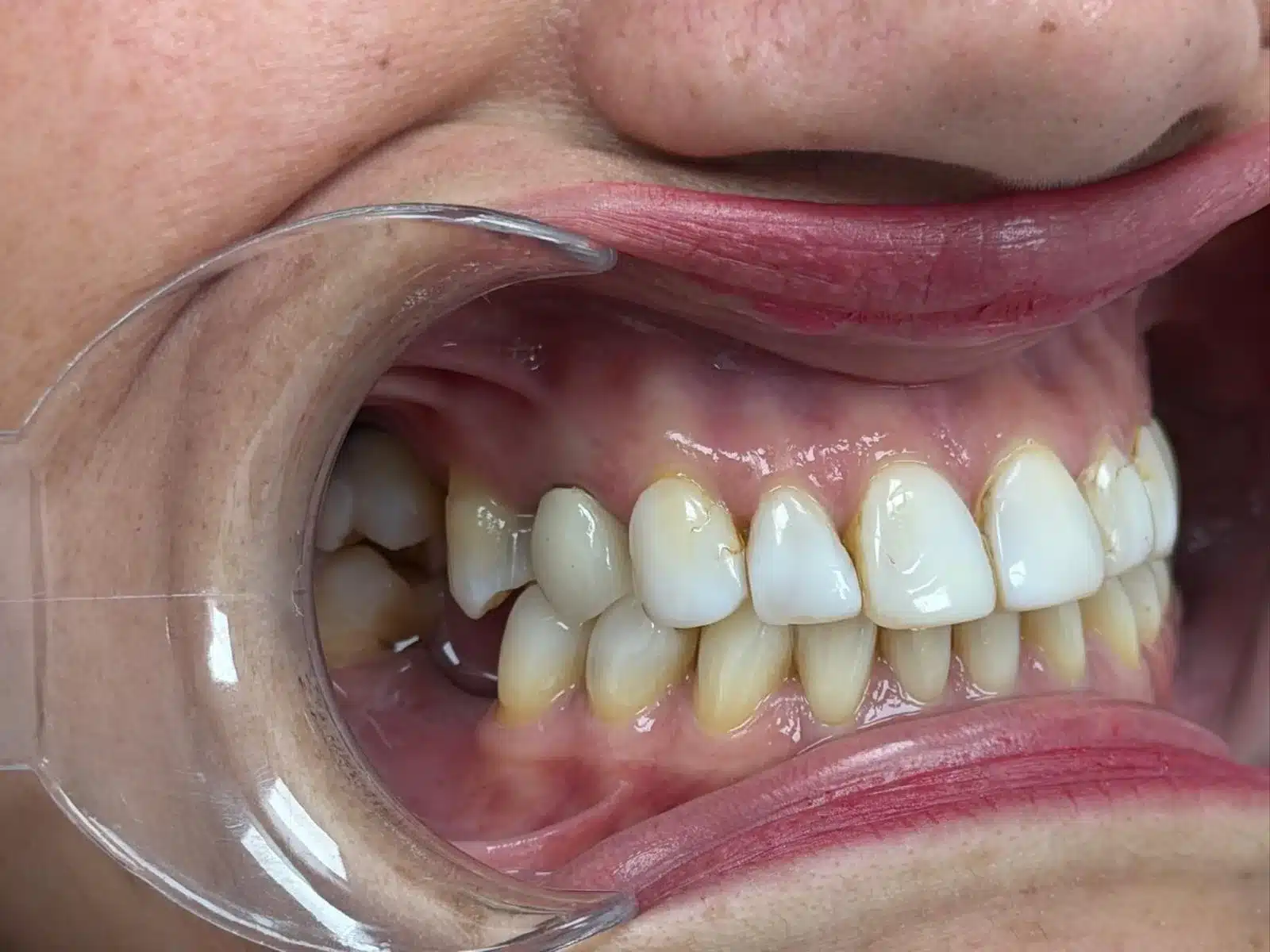 Estado de los dientes antes del tratamiento de carillas dentales Ilumine